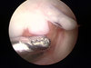 Knee Surgery - Gruesome Footage!